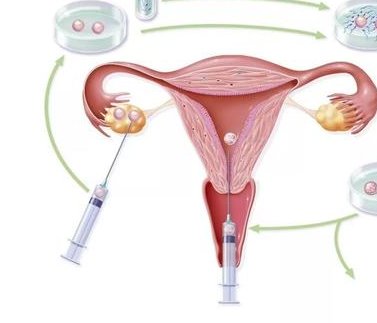 无锡三代试管婴儿费用组成，附试管注意事项